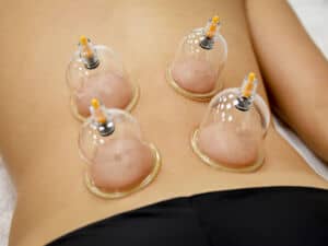 Corso coppettazione sportiva ed estetica: di cosa si tratta?