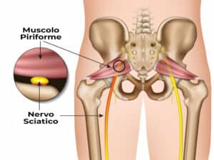 Sciatalgia o sindrome del piriforme?