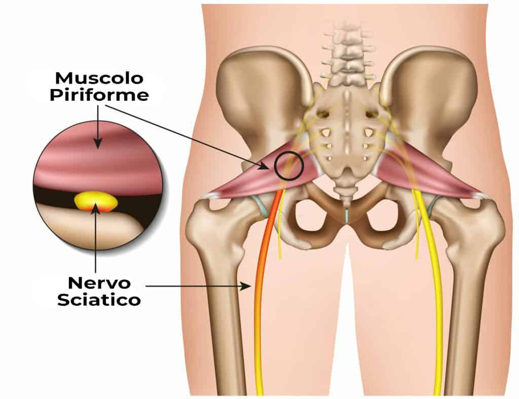 Dolore sciatico e piriforme: cause e trattamento fisioterapico - Evolution Academy®.