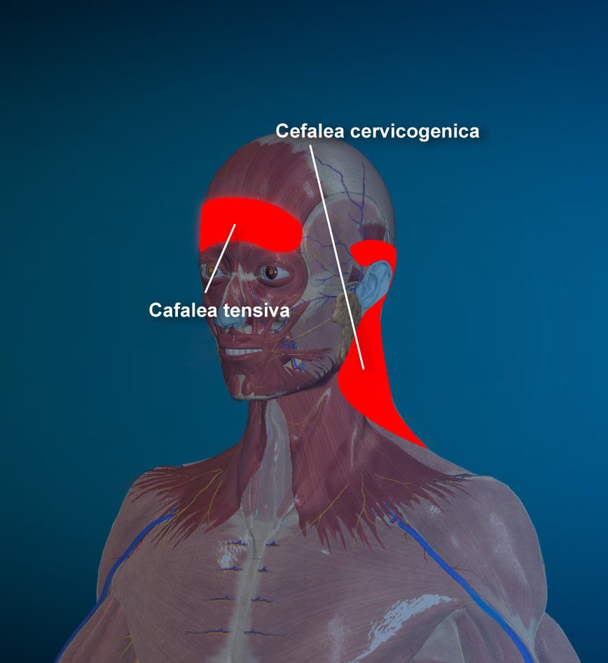 Mal di testa - Evolution Academy